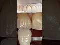 Layered zirconia crowns that we just finished in my lab for Dr. Omar Cruz in Puerto Rico