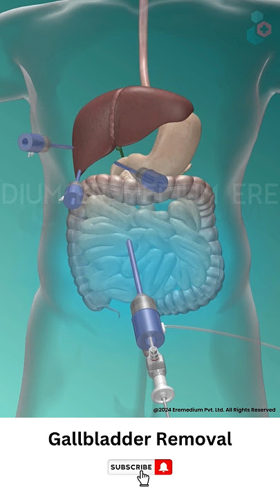 Gallbladder Removal Surgery ↪ 3D Medical Animation #Shorts #Gallbladder