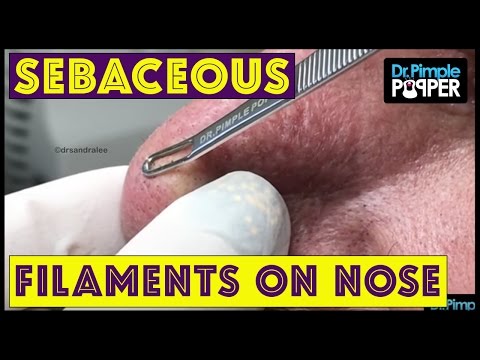 Sebaceous Filaments Extracted On The Nose