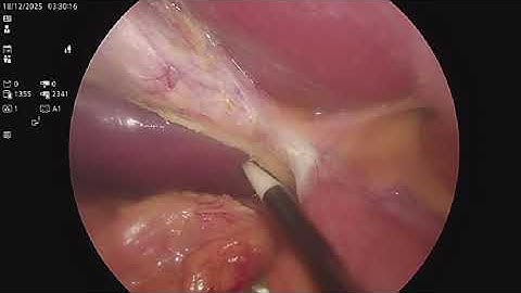 cholecystectomy