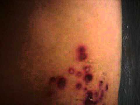 Kayap tapak anjing shingles herpes zoster - YouTube