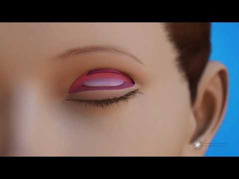 Video: Ptosis - Treatment, Causes, Surgery