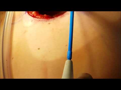 Breast Implant Removal Doctors Breast Implant Removal Lift Nashville Breast Implant Removal Doctors Breast Implant Removal Lift Nashville