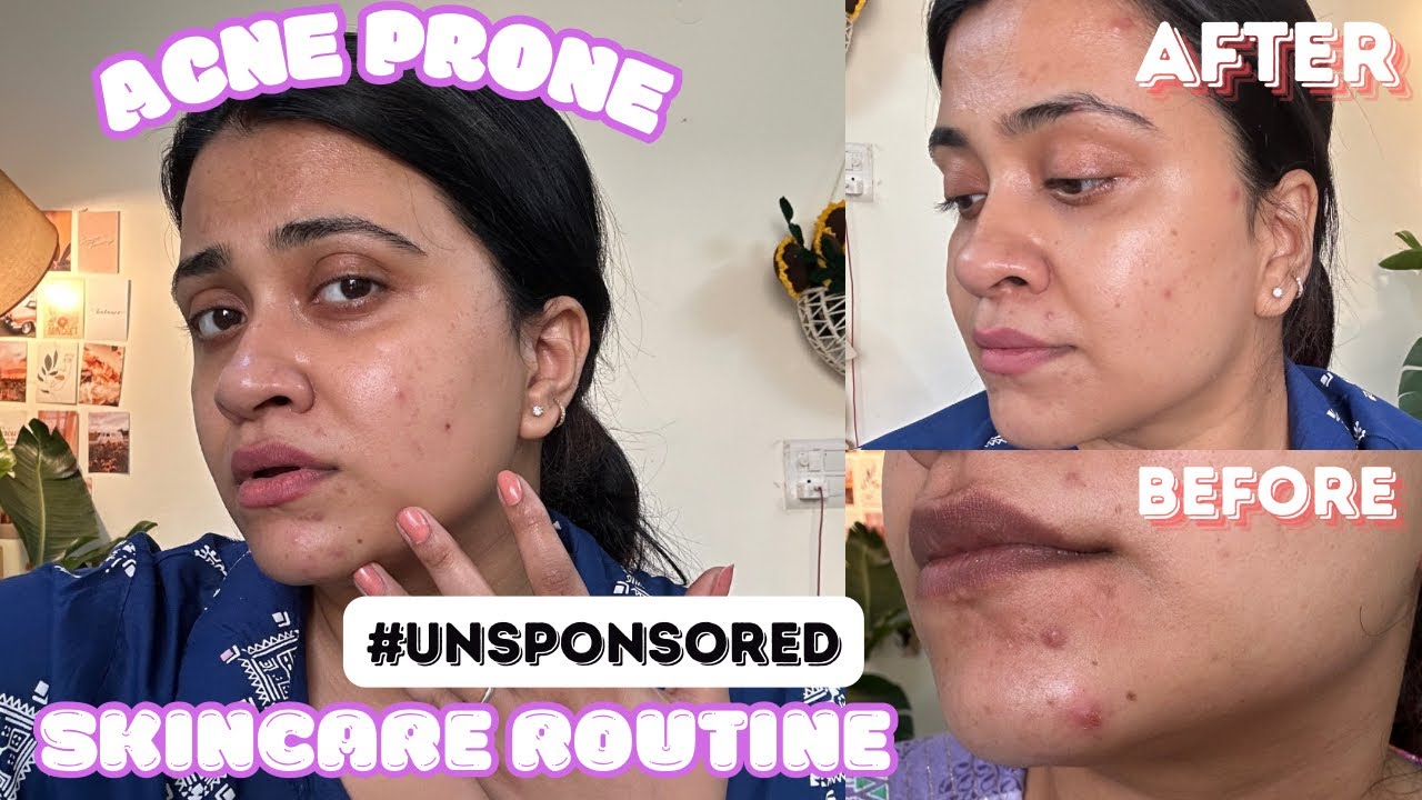 MY UNSPONSORED ACNE SKIN CARE ROUTINE/ Dealing with ADULT ACNE  / PCOS Hormonal Acne