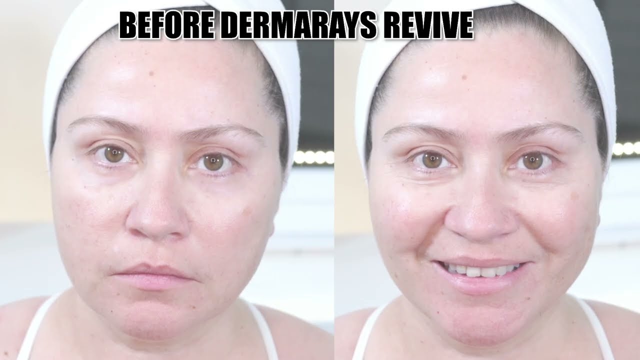 Professional Results at Home  30 Day Review of DermRays Revive Laser