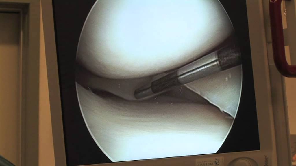Informatiefilm arthroscopie knie ziekenhuis St Jansdal te Harderwijk