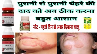 चेहरे के दाद का इलाज | Treatment of Fungal Infection On Face | चेहरे के Fungal Infection का इलाज