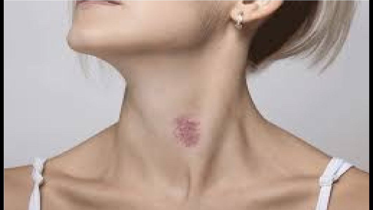From Hickey To Heiress How To Remove Hickey In Seconds For Instant Results - ph9fvke