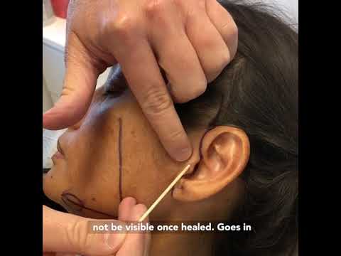 Facelift Incisions |
