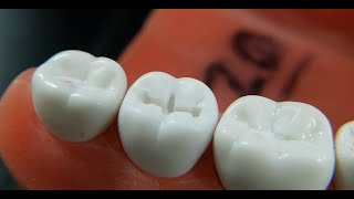 Class I Prep with Amalgam Filling on Tooth #31