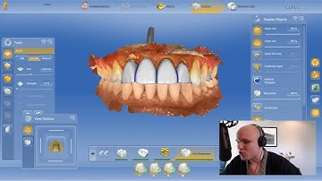 How To DESIGN Anterior Implant cases w/ CEREC