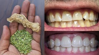 बस 5 मिनट में गंदे-पीले दाँतो को सफेद करे एवं दांत के कीड़े खत्म करे | teeth whitening | dant safed