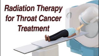 Throat Cancer Treatment with Radiation Therapy - Short Version