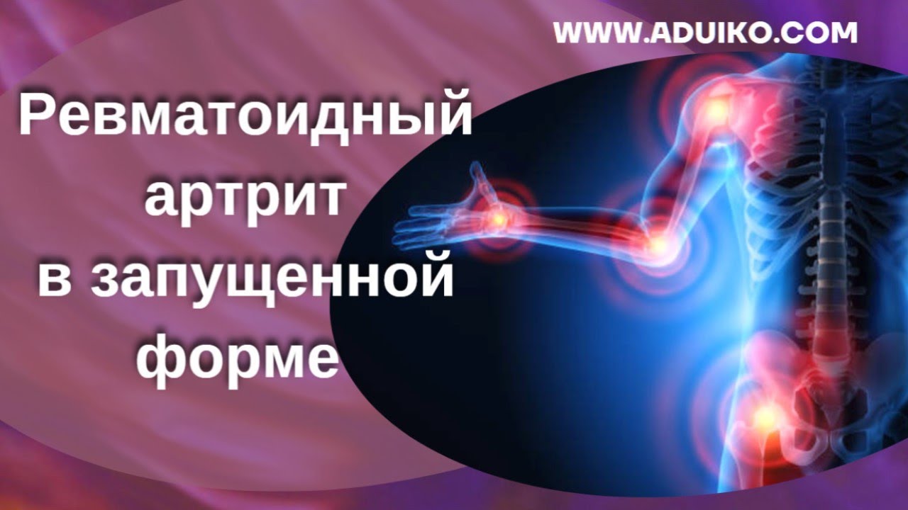 Ревматоидный артрит в запущенной форме - YouTube