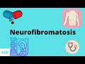 Neurofibromatosis, Causes, Signs and Symptoms, Diagnosis and Treatment.