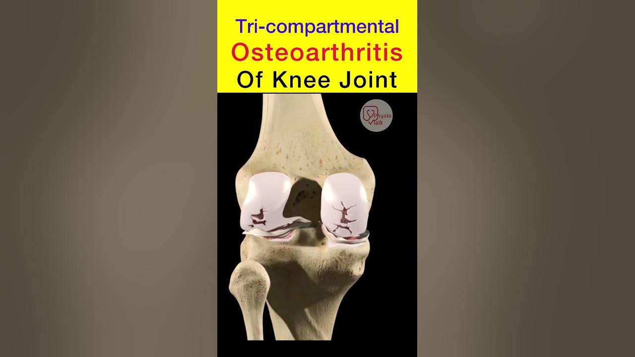 Tri compartmental osteoarthritis of knee joint shorts osteoarthritis
