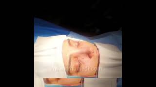 مباشر بعد عملية تجميل الأنف | دكتور حسين حامدي
