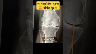 Arthritis Knee 🆚 Normal Knee घिसा हुआ घुटना | आर्थराइटिस से गैप पूरा कम हो गया #arthritistreatment