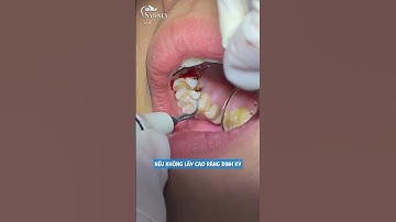 Lấy cao răng có làm hỏng mem răng không?#laycaorang #dentist #trend #nhakhoahanoisydney #tintuc #typ