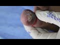 Ep_2119 Ingrown toenail removal 👣 ไม่ต้องกังวล..ออกง่าย 😷 (This clip is from Thailand)