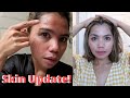 RYX Clear Bomb for 15 DAYS EXPERIENCE AND RESULT | MY Skin Journey (Hormonal Acne) | JanenElodie