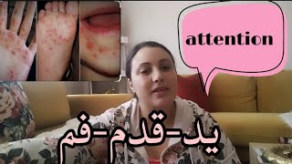 فيروس موجود بقوة حاليا                                syndrome pieds-mains-bouche