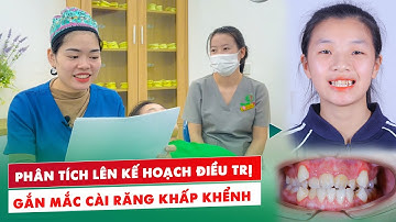 Trực Tiếp Bác Sĩ Phân Tích Lên Kế Hoạch Điều Trị Case Gắn Mắc Cài Điều Trị Răng Khấp Khểnh