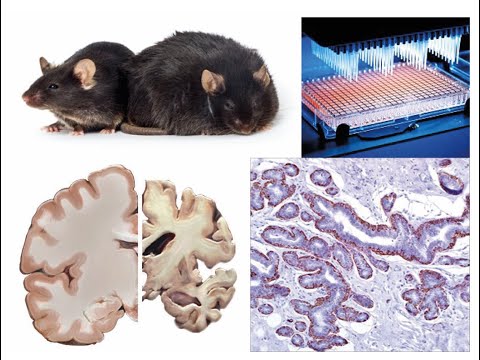 Vidéo: Pronostic Du Cancer Du Sein Micropapillaire Invasif Lymphotrope Analysé à L'aide Des Données De La National Cancer Database