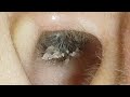 【耳掃除】#152 〜出そうで出ない 耳毛に守られた耳垢〜 earwax