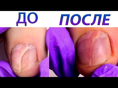 Ремонт ногтя акрилом. Как решить проблему глубокой трещины со смещением - Ремонт ногтя акрилом. Как решить проблему глубокой трещины со смещением