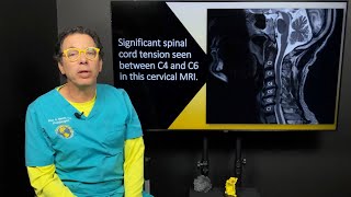 Internal tremors, whole body vibrations, & the connection to neck instability & spinal cord tension