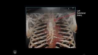Plain Film Cardiac And Vascular Anatomy - Frontal Radiograph - Philip Araoz, M.d. - Part 5 Of 10