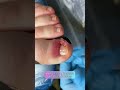 Вросший ноготь. ingrown nail. Как удалить вросший ноготь? Работать вслепую, опираясь только на опыт?