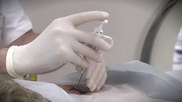 CT lung biopsy performed using SimpliCT laser navigation system HD