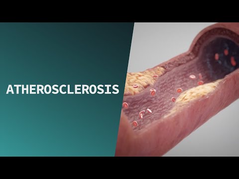 Video: Kas yra aterosklerozė, arteriosklerozė ir arteriosklerozė?