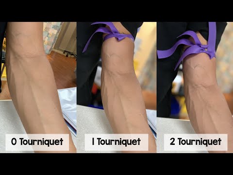 Two Tourniquets to Increase IV Access Success