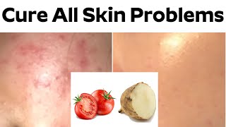 Cure All Skin Problems | SkinTan, OilySkin, Pimples, Blackheads,  And All | Solved This Home Remedy