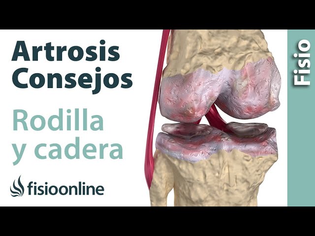 que tomar para la artrosis