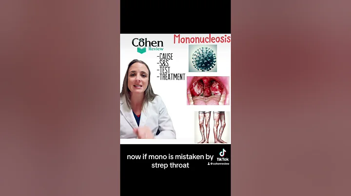 Mononucleosis for NP Boards