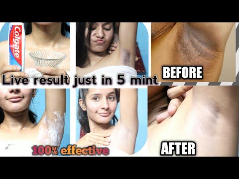 Underarms whitening 100% effective live result || in hindi || home remedies ||