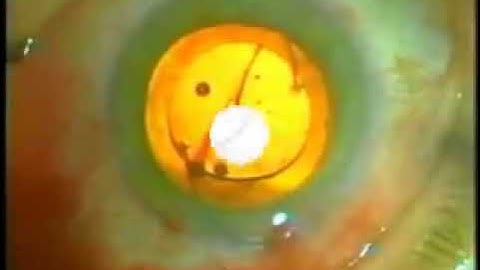 IOL Placement and Centration (including sulcus placement)