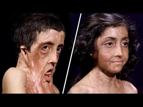 ЧУДЕСА ХИРУРГИИ! Девочка восстановилась после тяжелейших ожогов