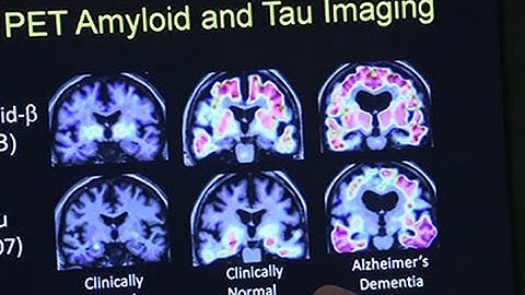 New Research May Help Prevent Alzheimer