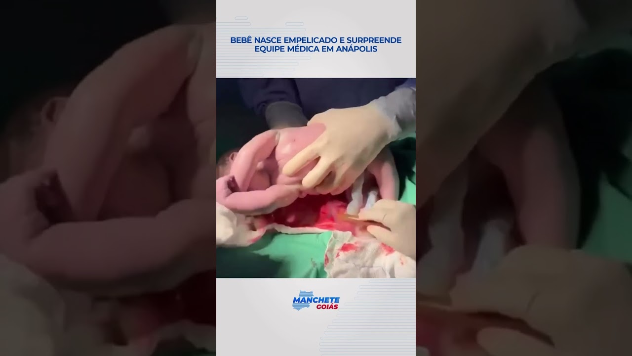 bebê nasce empelicado e surpreende equipe médica em Anápolis
