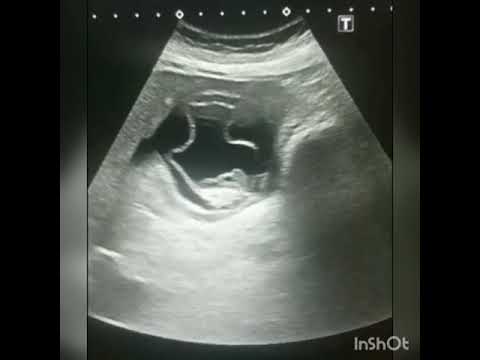 Ultrasound video showing a hydatid cyst in liver (water Lily sign) in transitional stage CE3