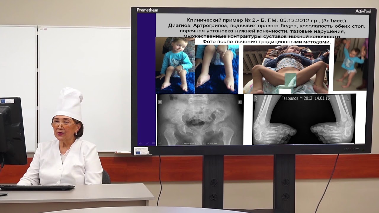Лекция "Лечение врожденного вывиха бедра у детей раннего возраста по Алимхановой Р.С.".