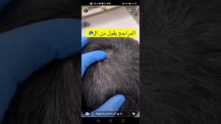 هل لبس القبعه له علاقه بتساقط الشعر؟(سناب الدكتور أنور الحمادي)