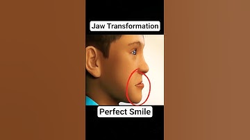 Watch How a Misaligned Jaw Gets Perfectly Aligned #Shorts