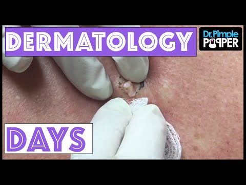 Dermatology Days With Dr Pimple Popper