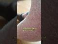 A Psoriasis Success Story You Need to See #shorts